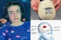 Britaniyalı yeniyetmənin beyninə implant yerləşdirilib